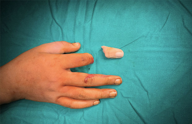 Cắt Cụt Chi Và Những Vấn Đề Cần Quan Tâm