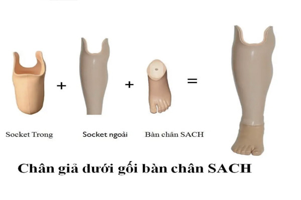 chi phí làm bàn chân giả