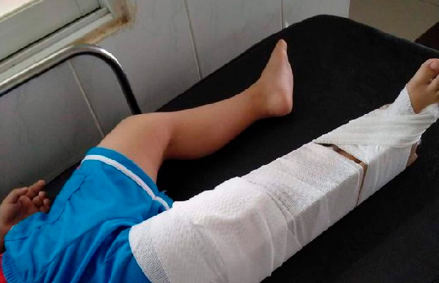 Gãy Xương Và Biến Chứng: Tư Vấn Từ Chuyên Gia