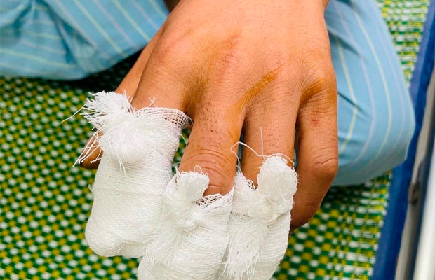 Hoại Tử và Nhiễm Trùng ở Mỏm Cụt: Cách Xử Lý