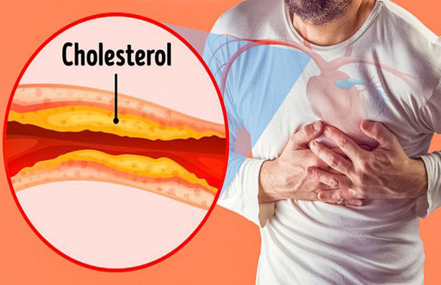 Tắc Nghẽn Động Mạch Là Gì? Biến Chứng Ra Sao?