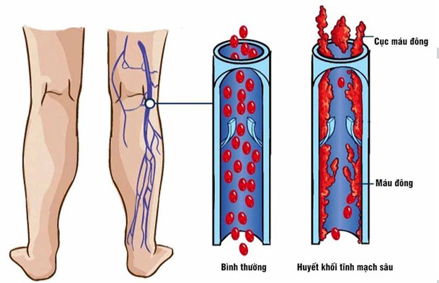 khi nào cần sử dụng chân tay giả