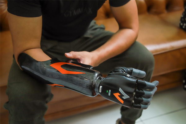vai trò của việc lắp tay giả